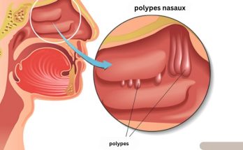 Les polypes nasaux peuvent-ils être la cause de votre nez bouché ?
