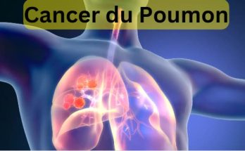Qu'est-ce que le Cancer du Poumon? | Types de cancer du poumon